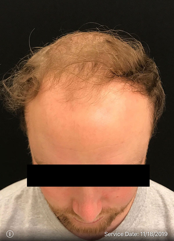 NeoGraft