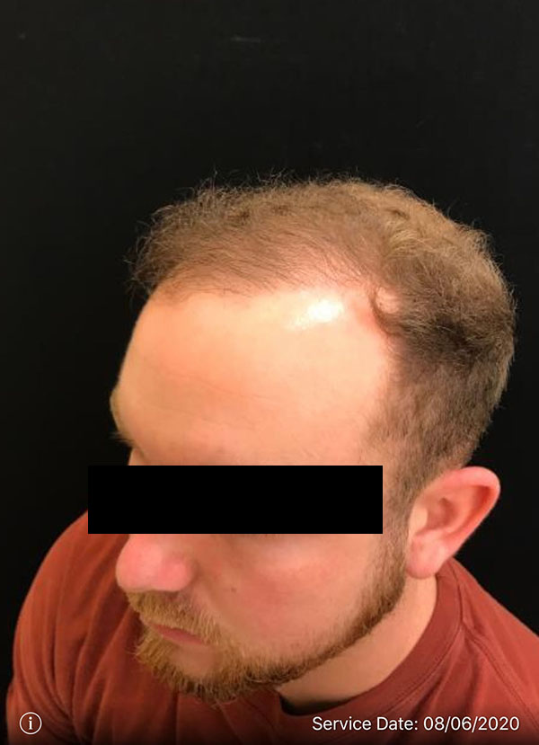 NeoGraft