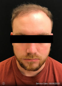 NeoGraft
