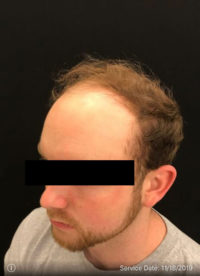 NeoGraft