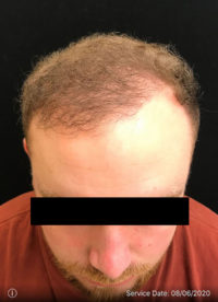 NeoGraft