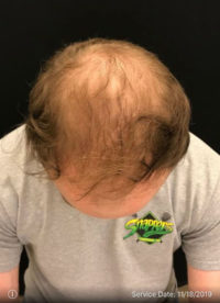 NeoGraft