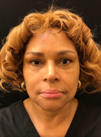 Facial Fat Grafts