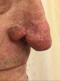 Dermatologic Surgery