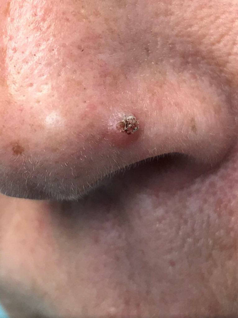 Dermatologic Surgery