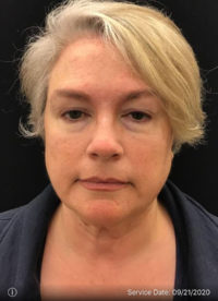Facetite