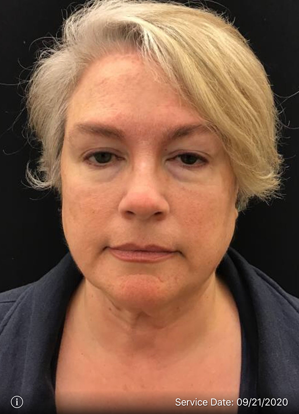 Facetite