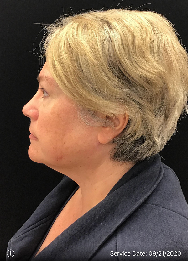 Facetite