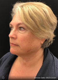 Facetite
