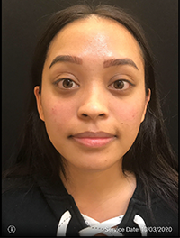 Around The Eye Fillers