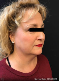 Facetite