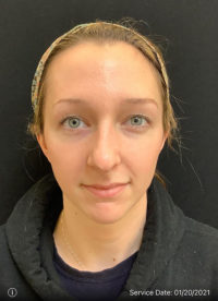 Nose Rejuvenation