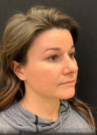 Nose Surgery
