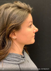 Nose Surgery