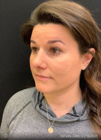 Nose Surgery