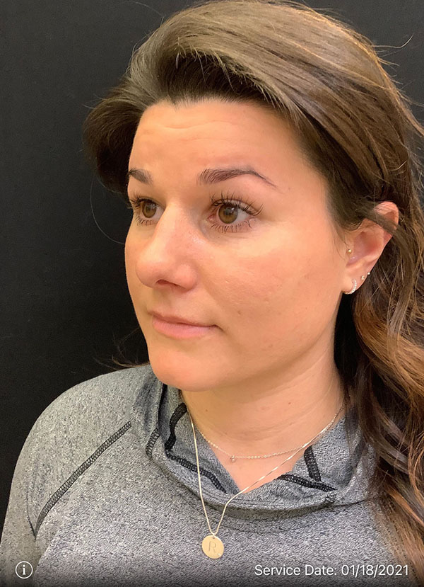 Nose Surgery
