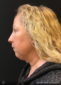 Facetite