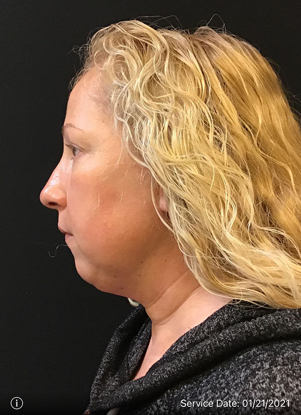 Facetite