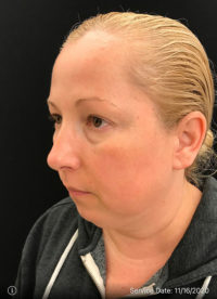 Facetite