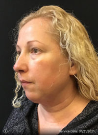 Facetite