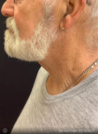 Incisionless Necklifts