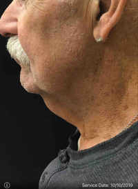 Incisionless Necklifts