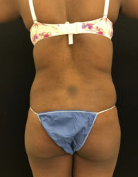 Brazilian Butt Lift
