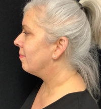 Facetite
