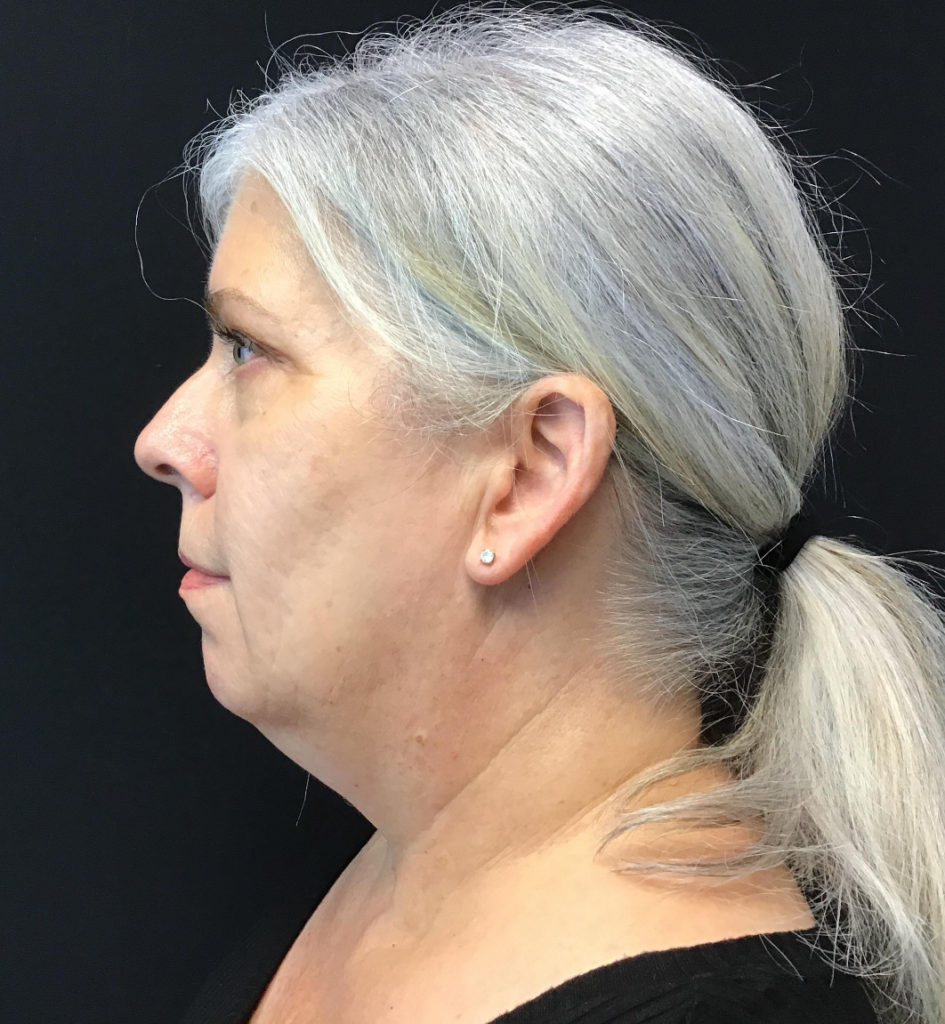 Facetite