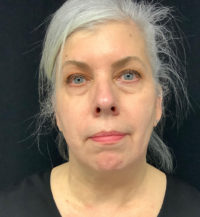 Facetite