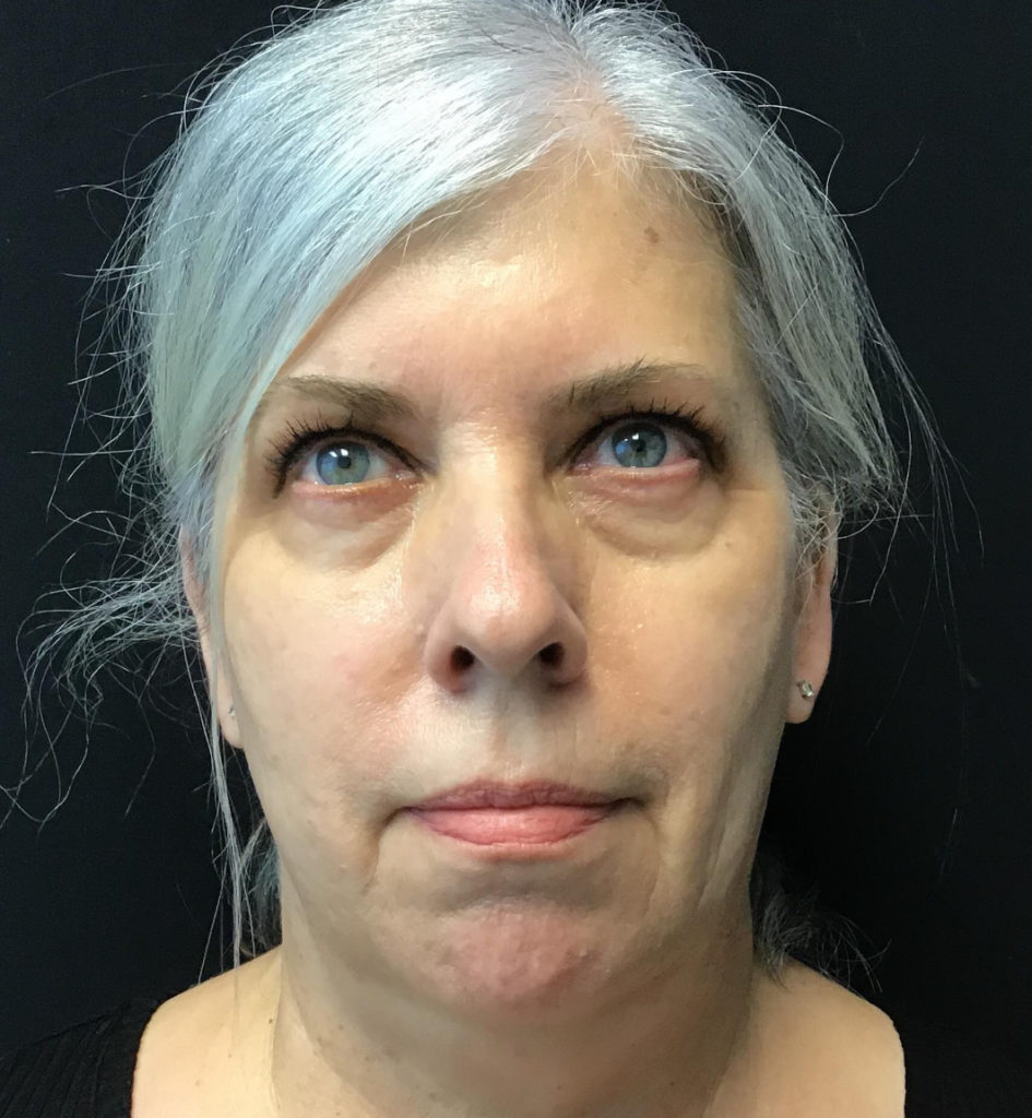 Facetite