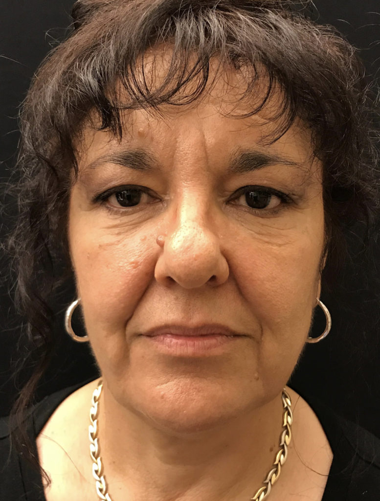 Facetite