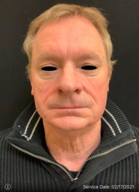 Facelift