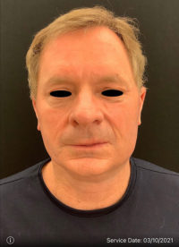 Facelift