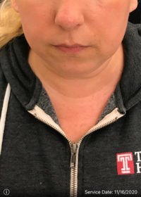 Facetite