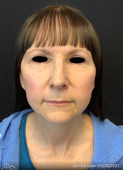 Facelift
