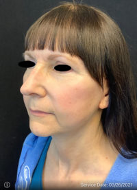 Facelift