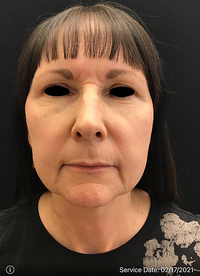 Facelift