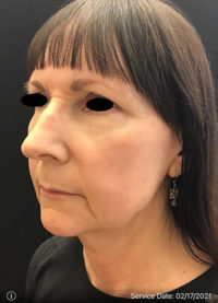 Facelift