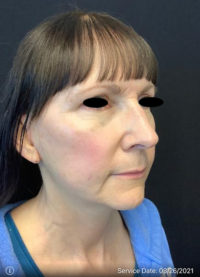 Facelift