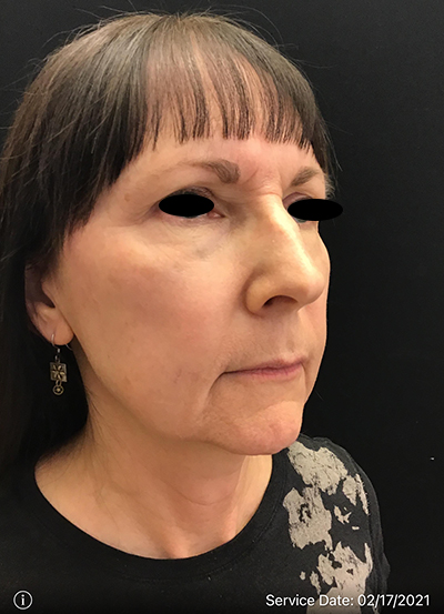 Facelift