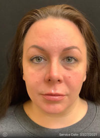 Nose Rejuvenation