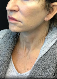 Facelift