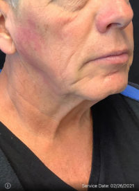 Facelift