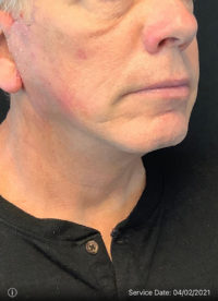 Facelift