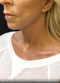 Facelift