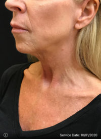 Facelift