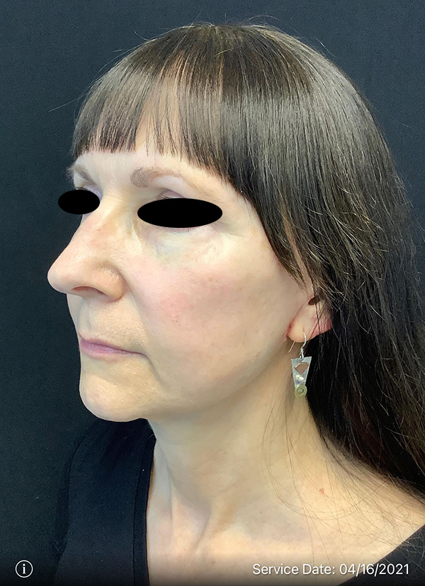 Facelift