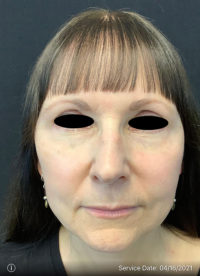 Facelift