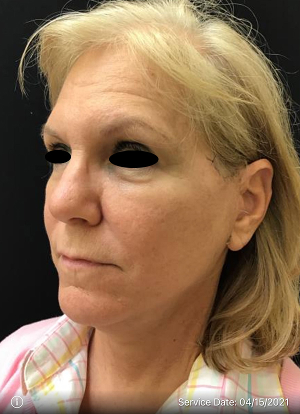 Facelift